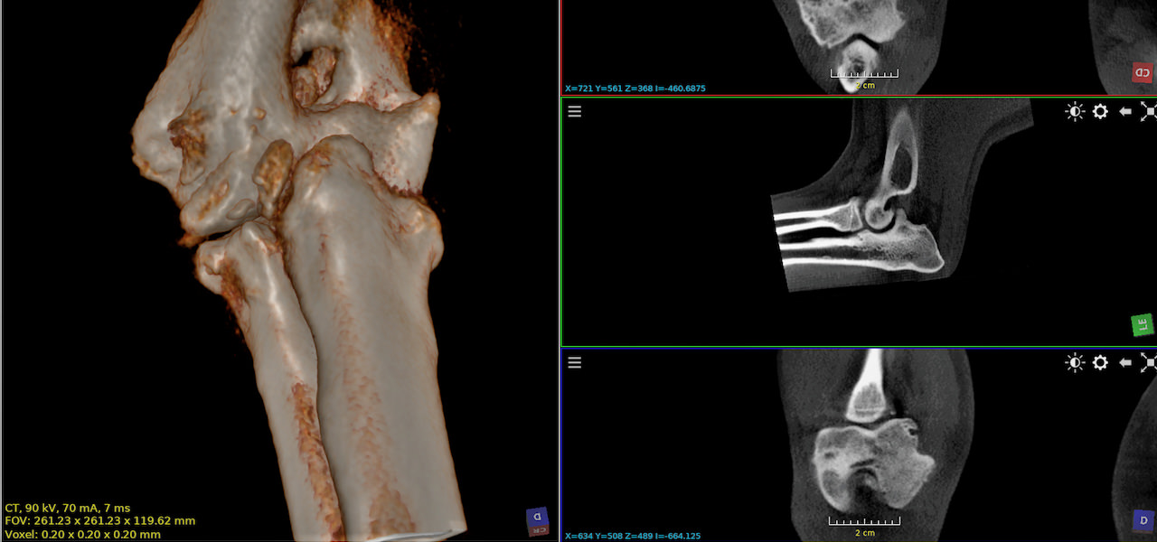 CT-Aufnahme eines Ellenbogen